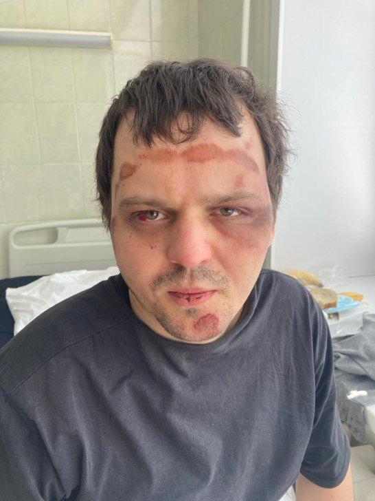 На снимке, который Александр сделал уже в больнице, видно, что у него разбит глаз, все лицо в синяках и ссадинах. Он говорит, что это травмы остались не только от падения / Фото предоставлено знакомыми Александра Желтухина