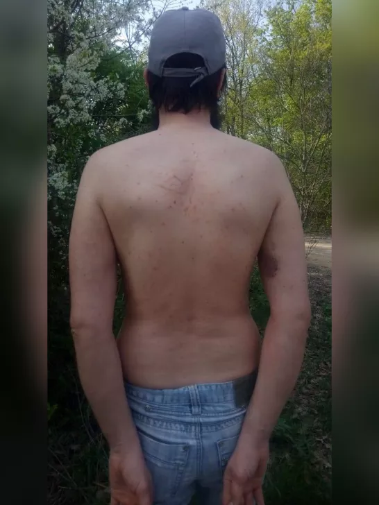 Отметины, оставшиеся на теле Федора Орлова / Фото предоставлено Федором Орловым