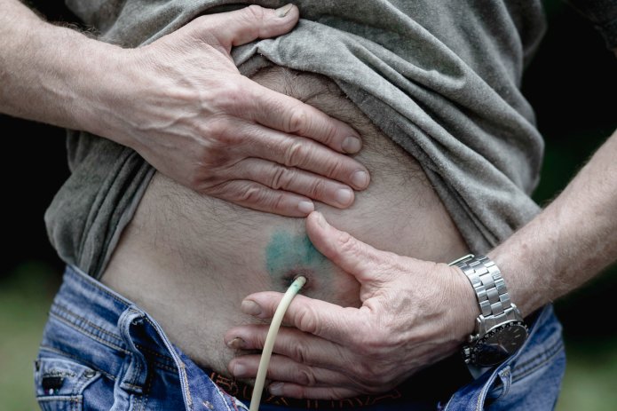 Igor Baryshnikov demonstrates his suprapubic cystostomy, a catheter inserted into the bladder and passing through the abdominal wall / Photo: OVD-Info