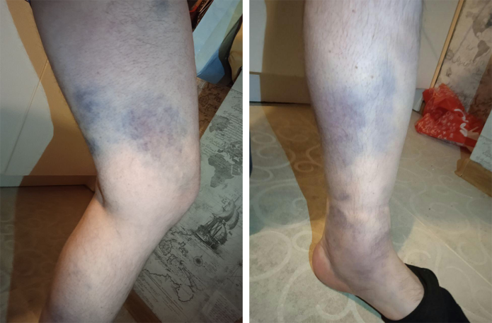 <em>Hematomes on the legs of the speaker. Photo: Internationalist Communist Organisation</em>